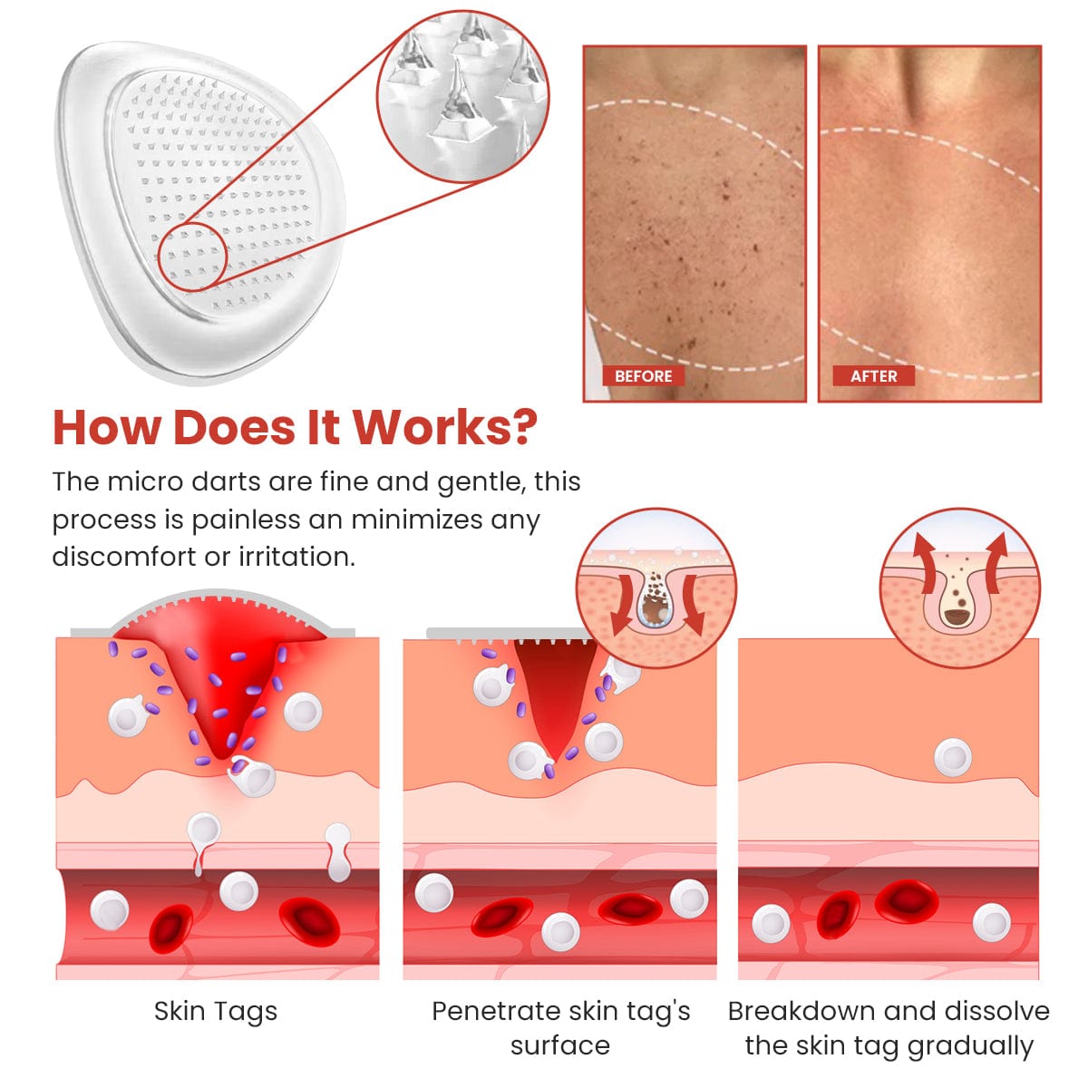 Coolord® DermaSmooth Skin Tag Remover Patch